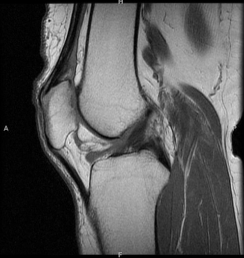 Figure 2 for case Sprained ligamentum mucosum